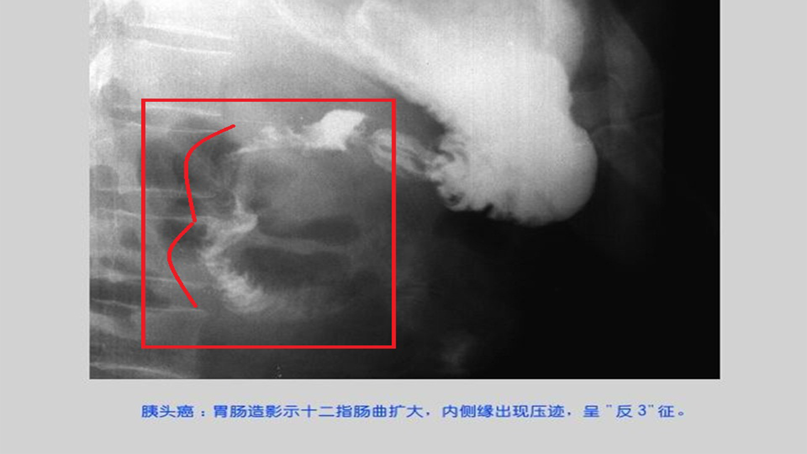 胰腺癌的早期诊断是世界性难题,胰腺癌核磁检出率