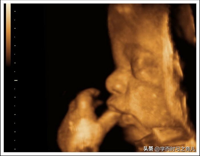 四维检查是好的但生下宝宝脚内翻,四维彩超通过后胎儿还会畸形吗