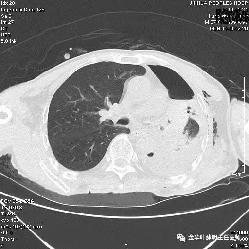 肺手术后乳糜胸是医疗事故吗,肺部切除后乳糜胸治好了