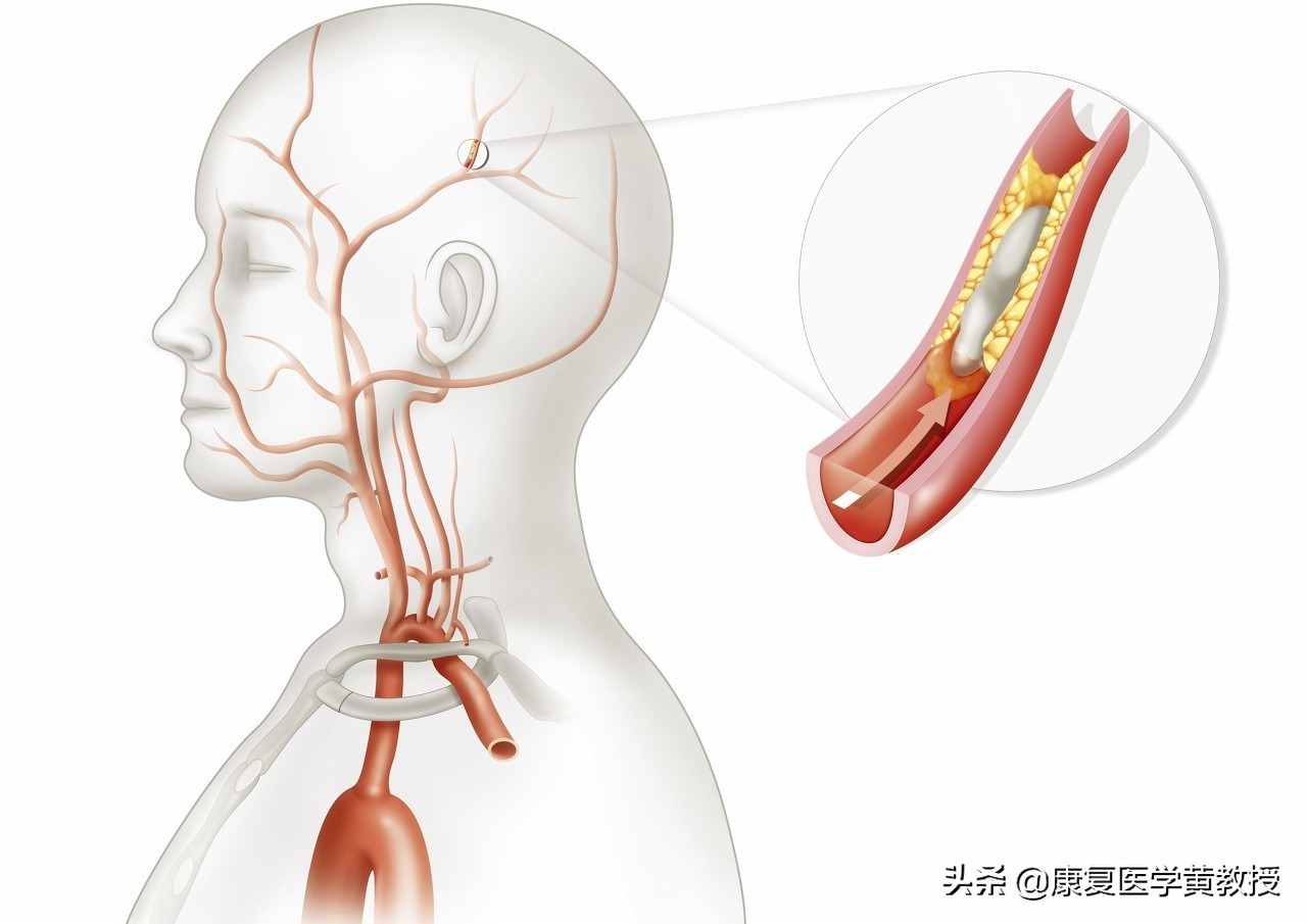 脑出血后遗症叫什么名字,脑梗中风后遗症怎么办