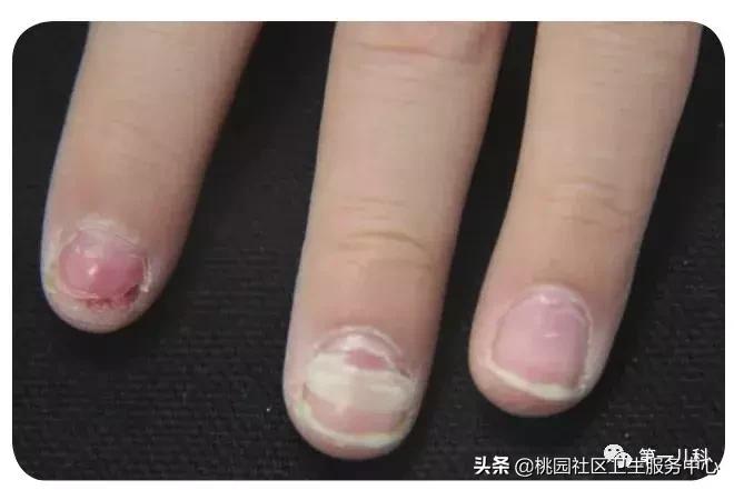 手足口病及水痘等传染病防控知识,手足口病和幼儿急疹和水痘的区别