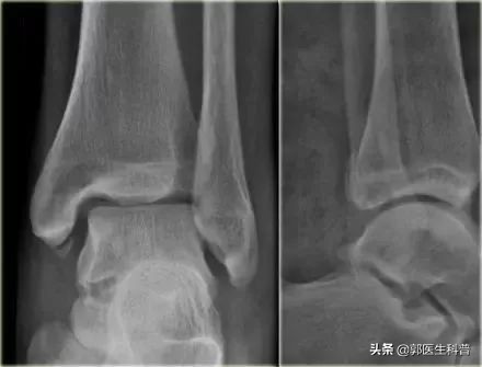 脚扭伤不敢着地怎么治疗,脚扭伤不尽快处理