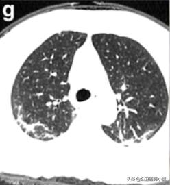 新型冠状病毒肺炎患者的肺,新型冠状病毒患者肺部体征