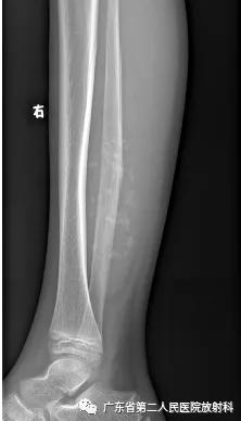 这个病例让我大涨知识：14岁男性右小腿痛性包块