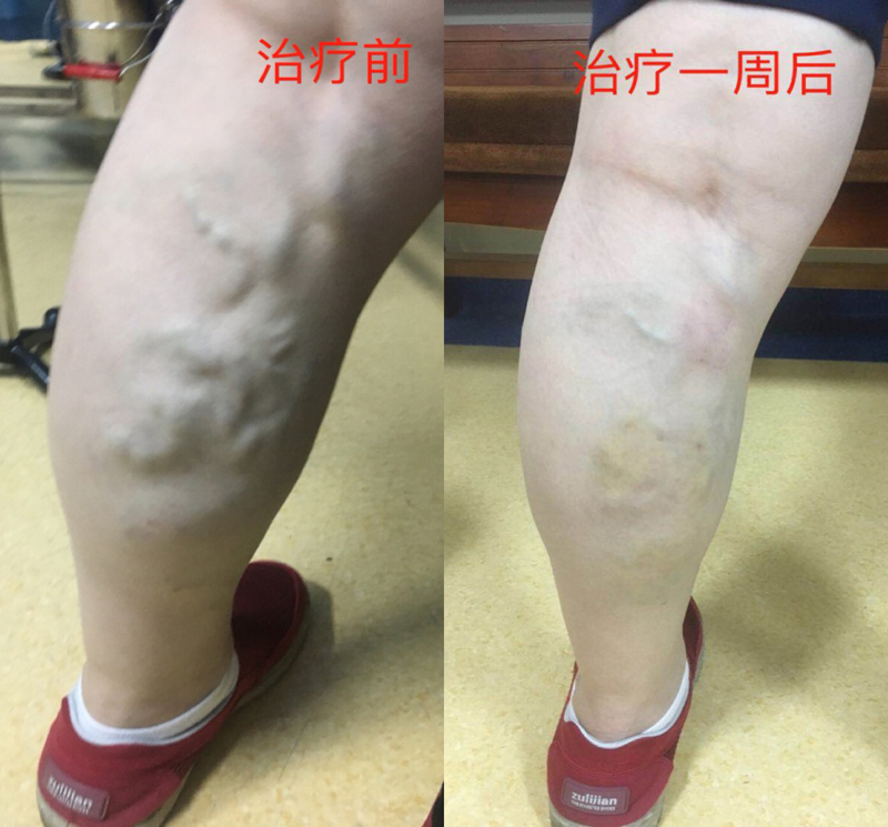 十堰市中医医院静脉曲张,中医针灸静脉曲张