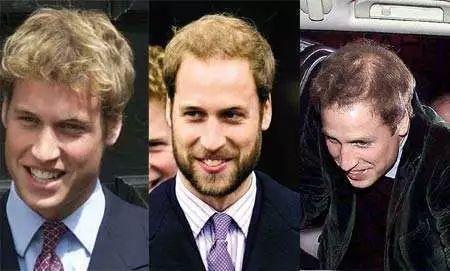 人到中老年脱发特别严重怎么治,人到中年如何摆脱脱发问题