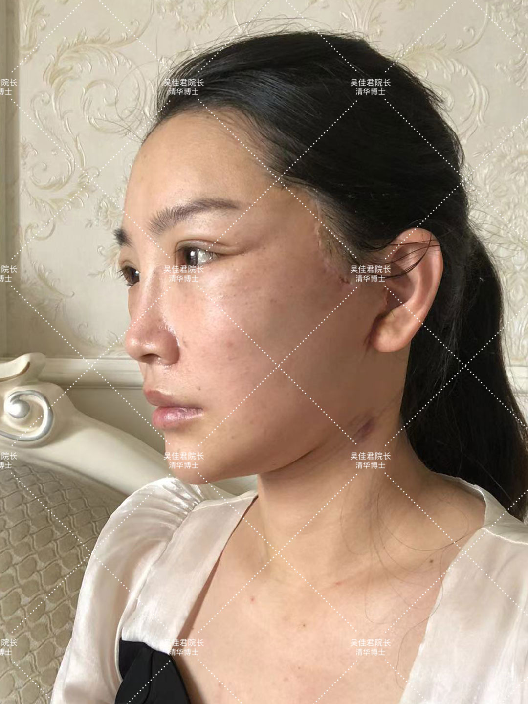 31岁做小拉皮,40岁做小拉皮的视频