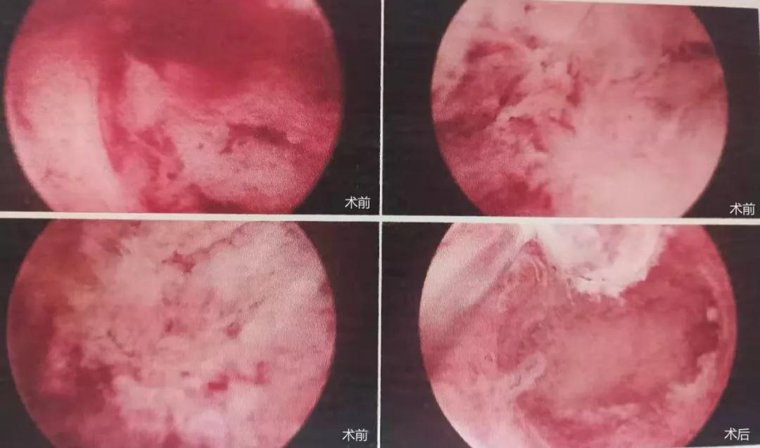 宫角妊娠住院要多久,宫角妊娠有没有生命危险