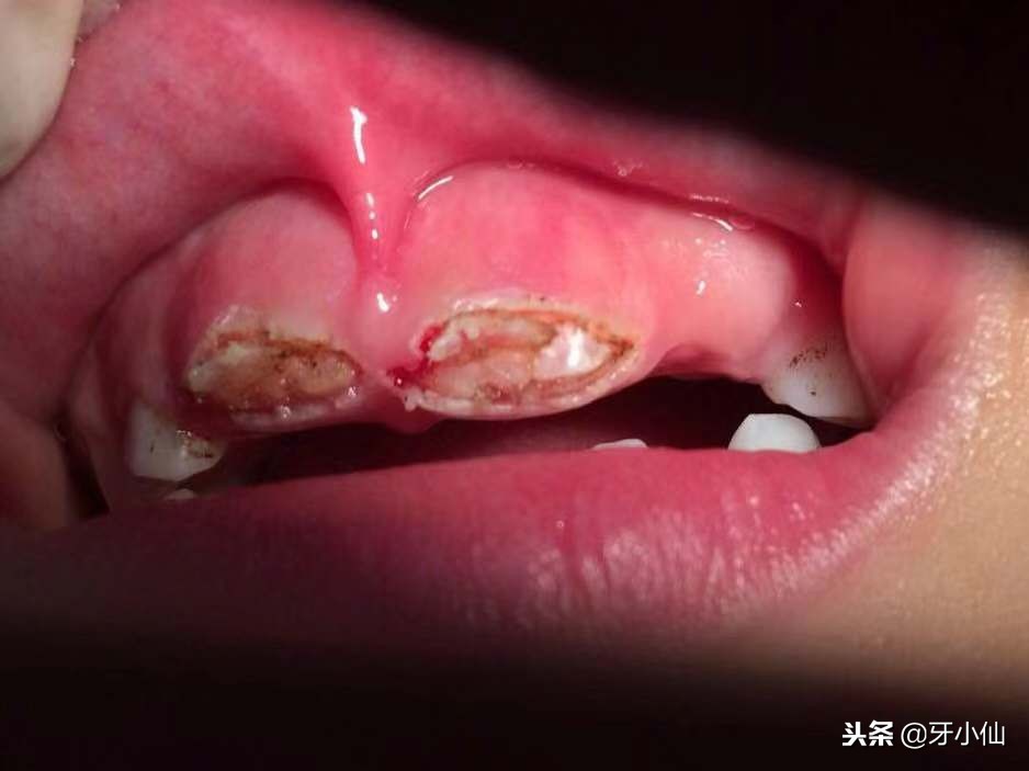 小孩牙长不出来割一下需要多少钱,儿童畸形牙拔了不长怎么办