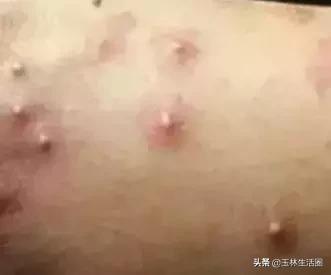 玉林一女子被蚂蚁咬,广东女孩被蚂蝗咬的真实视频