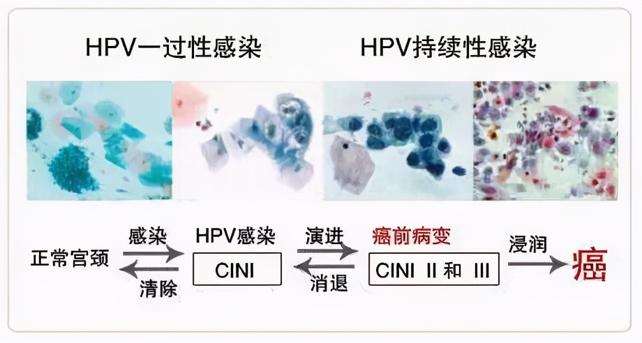 北京协和杨毅怎么治hpv,协和医院杨毅治疗hpv方法