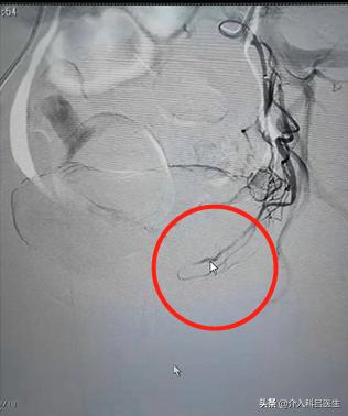 多发性子宫肌瘤二次复发怎么办,多发子宫肌瘤切除后又复发怎么办