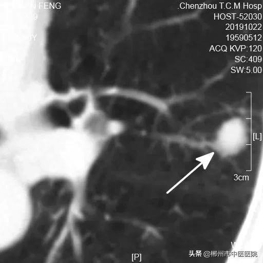 肺癌陀螺刀放疗后五年生存率,得了肺癌是不是不要轻易动手术