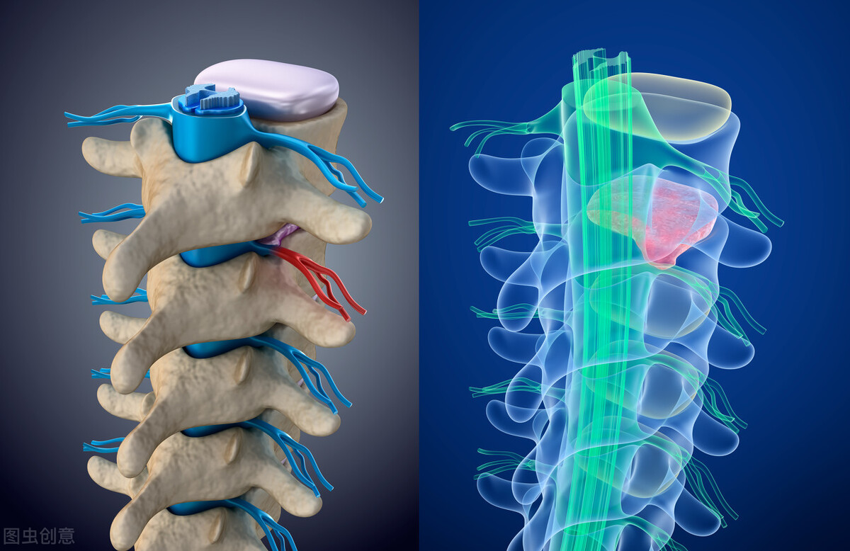 腰间盘突出没有保守治疗直接微创,腰间盘突出症不花钱自我康复疗法