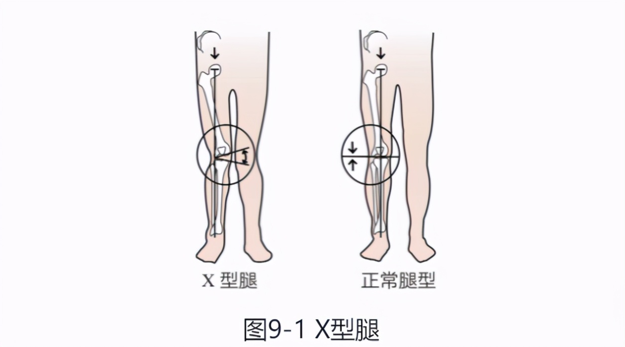 扁平足穿上了矫正鞋垫能跑步吗,扁平足跑步选减震还是缓冲