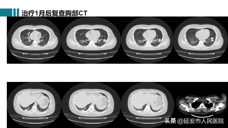 治疗肉芽肿性血管炎哪家医院好,嗜酸性肉芽肿性血管炎哪家医院好