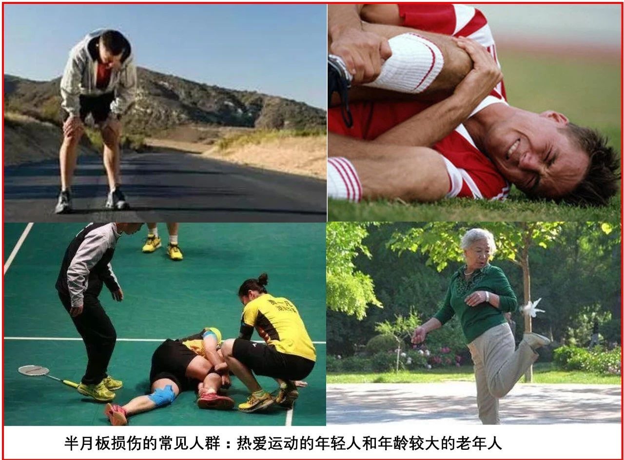 善待你的半月板,善待膝关节珍惜半月板