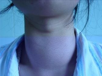 甲状腺自检中医,专家教你如何解读甲状腺超声报告