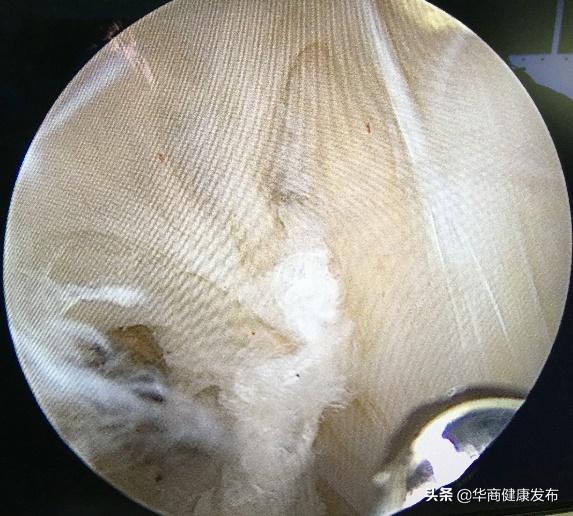 痛风发作在腿弯处有肿块,腿弯出现鸡蛋大肿块是怎么回事