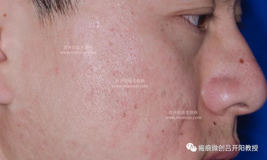 强脉冲激光治疗脸部视频,点阵激光嫩肤