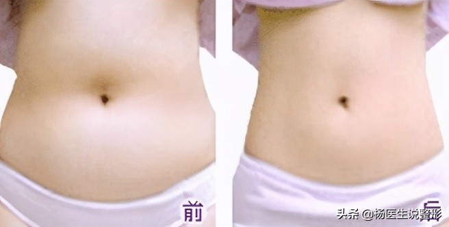 吸脂手术有哪几种类型,吸脂手术很微创