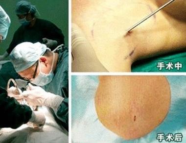 手术治疗腋臭到底好不好,腋臭手术后如何恢复治疗