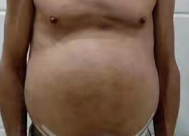 鼓胀中医诊疗案例：面对不同时期的肝硬化，我们应该怎么办？