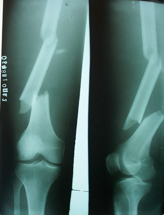 开车撞人致脱臼或骨折赔偿多少,交通事故撞人腿骨折全责赔偿标准