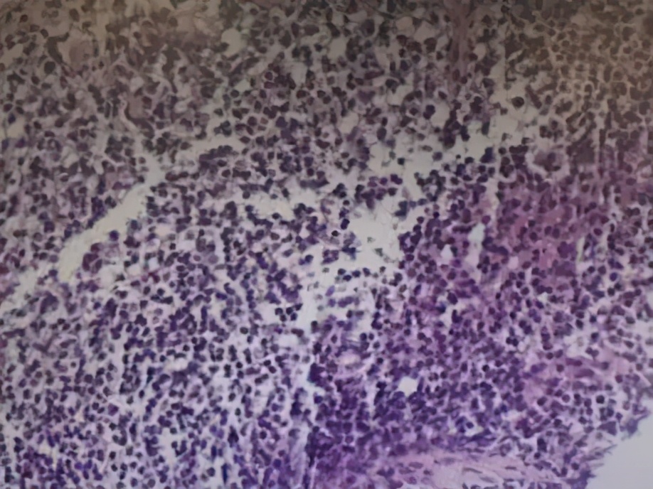 肺部肿块抗炎治疗无变化怎么办,病灶呈轻中度持续强化