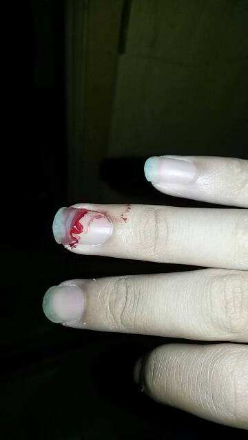 指甲盖劈了手指肿怎么办,指甲劈了咋处理啊