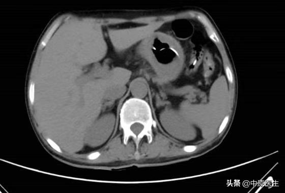 女子用洁厕灵中毒,因抑郁症误服洁厕灵算工伤吗
