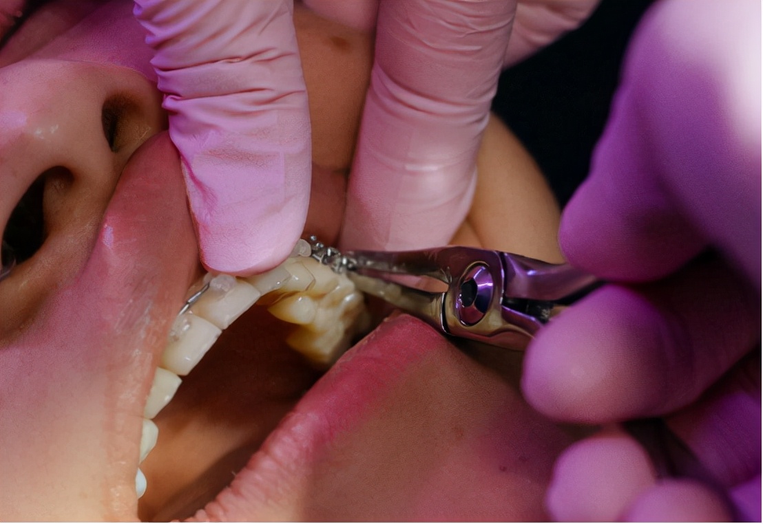 想戴牙套但是很贵怎么办,想戴牙套但是要钉钉子怎么办