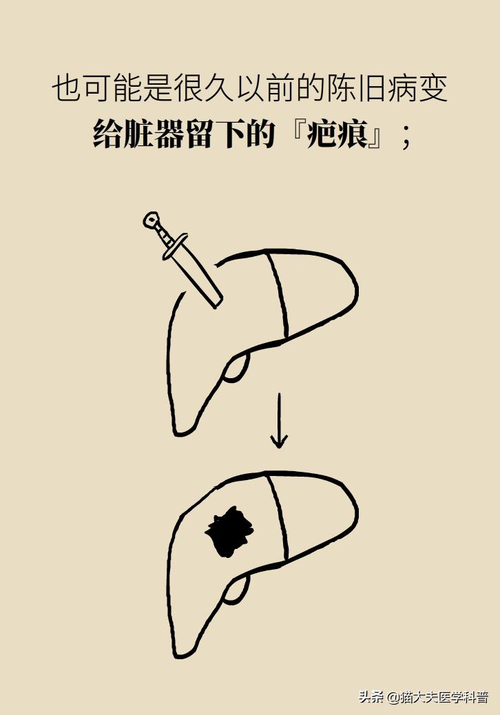 结节囊肿息肉的区别,结节增生囊肿息肉哪种癌前病变