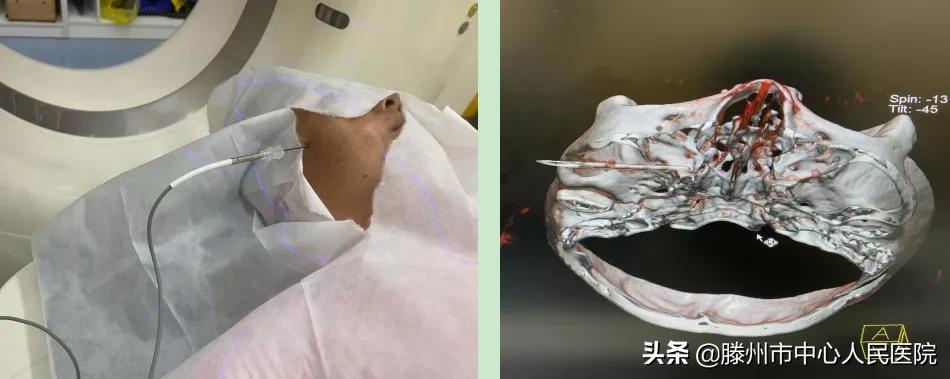 偏头痛射频微创治疗会复发吗,丛集性头痛做微创手术可以痊愈吗