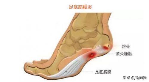足底筋膜炎可以练瑜伽吗,瑜伽足底筋膜炎康复训练