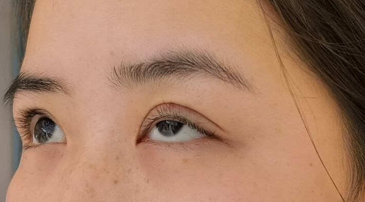 眼睑下垂手术5天恢复图,眼睑下垂手术15天照片