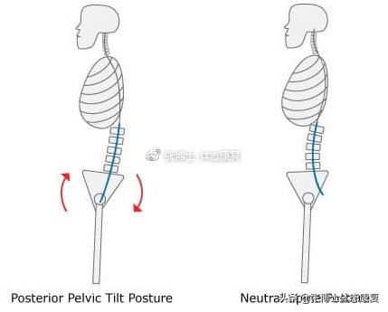 有什么动作可以矫正骨盆后倾,骨盆后倾体态纠正训练瑜伽小队长