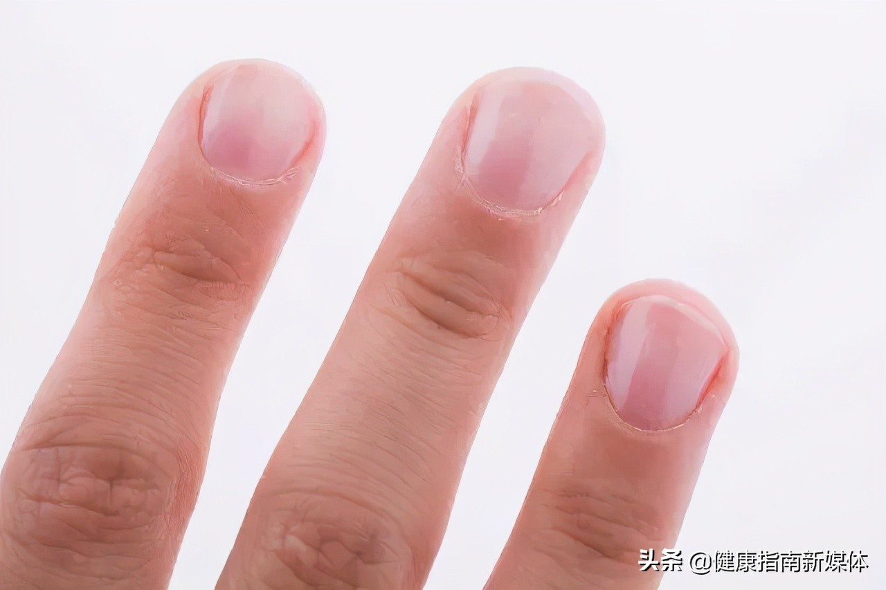 如何治疗灰指甲引起真菌感染,如何治疗灰指甲