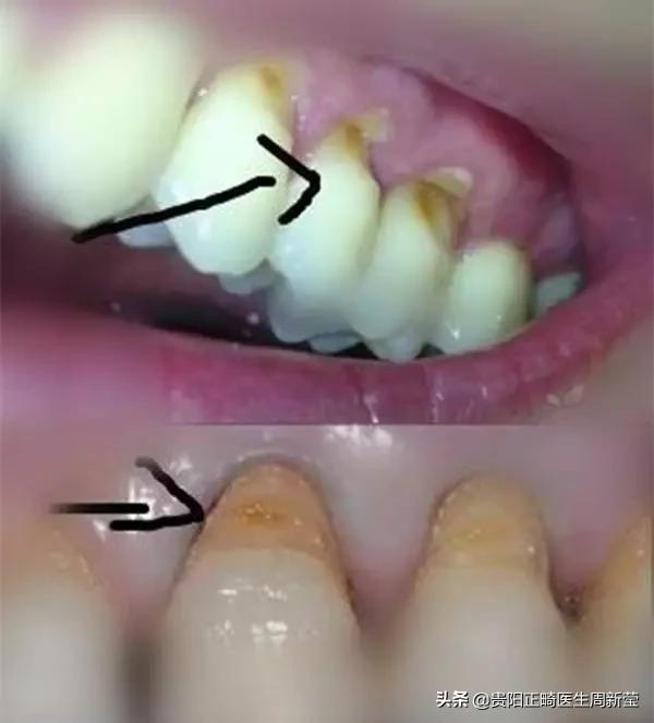 正确的刷牙方法是横刷法对不对,刷牙方法是横刷法还是竖刷牙法