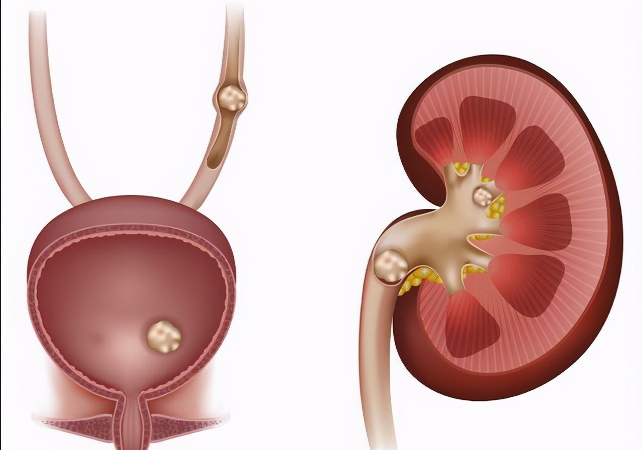 体检查出有肾结石要关注什么,查出有肾结石要关注什么