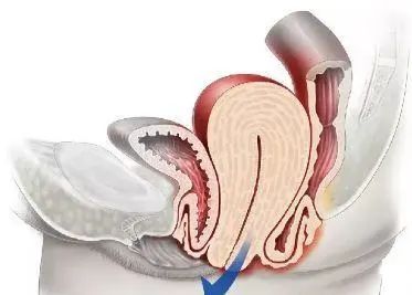 直肠脱出是什么形状,直肠脱出30厘米