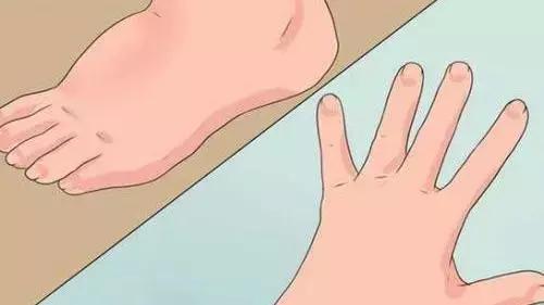 水肿的病因病机,水肿病因病机及辨证论治思维导图