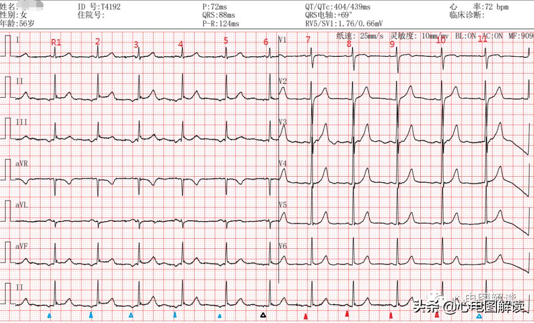 心房下部游走性心律什么意思,心房到窦房结游走性心律什么意思