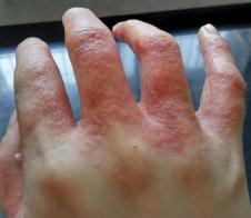 手足长小水泡越抓越痒,发烧过后手足长红疹变水泡
