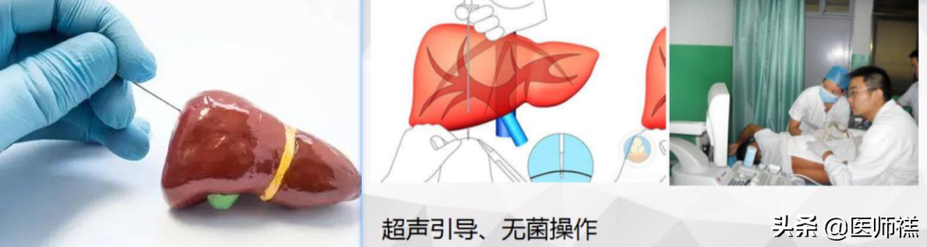 肝囊肿穿刺和微创切除哪个风险大,肝脏穿刺风险和后遗症
