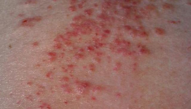 湿疹最怕这四样,湿疹最怕的五种行为千万别做