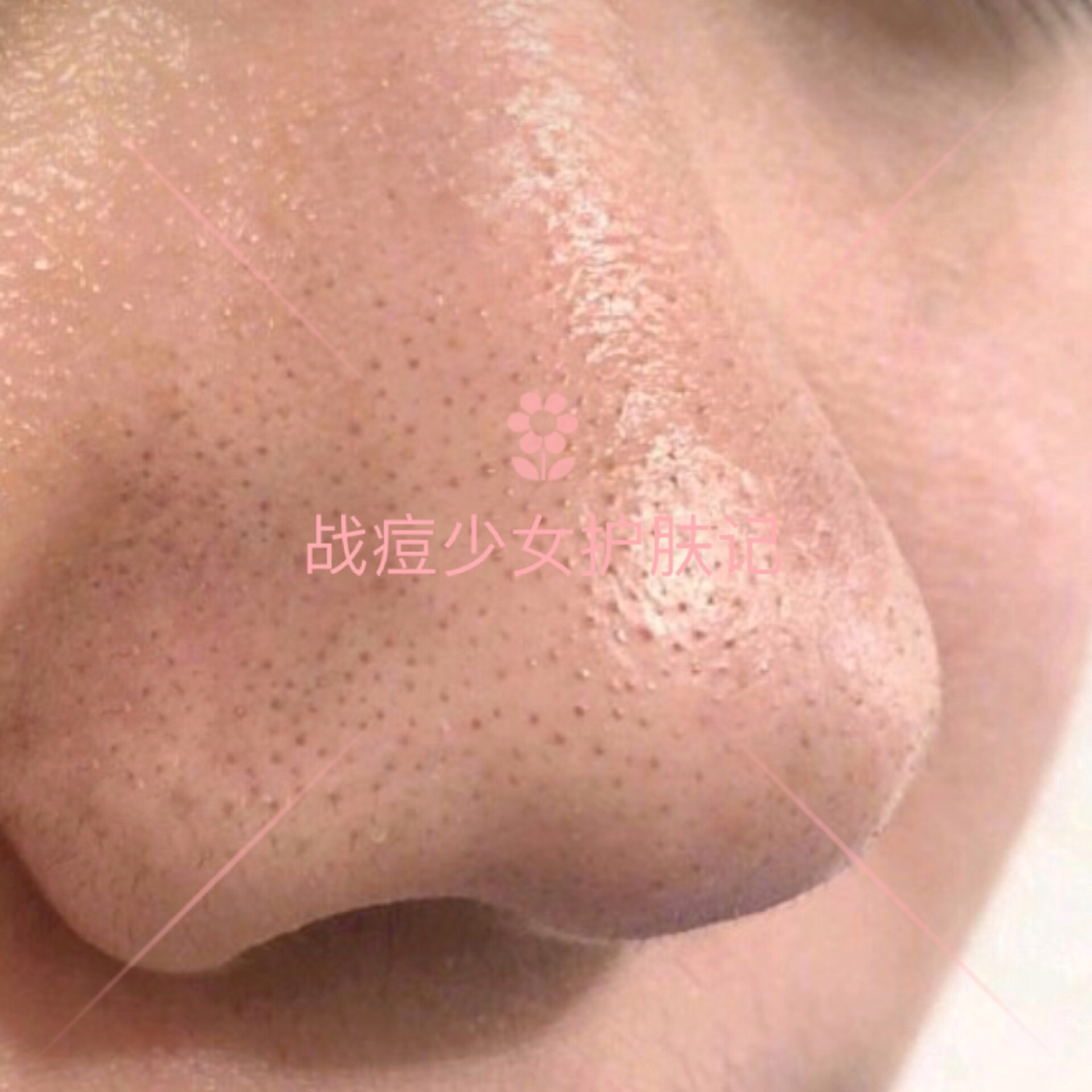 四种痘痘最佳治疗方法,各种痘痘的对症用药