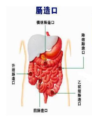 肠癌造口回纳后容易引起复发吗,肠癌术后有回肠造口怎么饮食