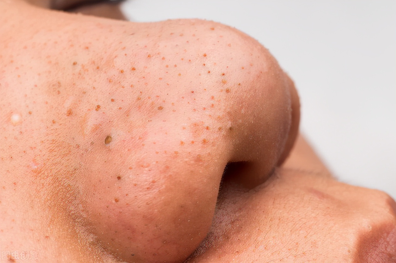 手把手教你有效去黑头的方法,最有效去黑头方法推荐