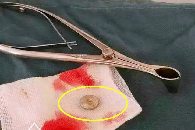 孩子误吞了纽扣电池怎样取出来,3岁小孩误吞纽扣怎么办